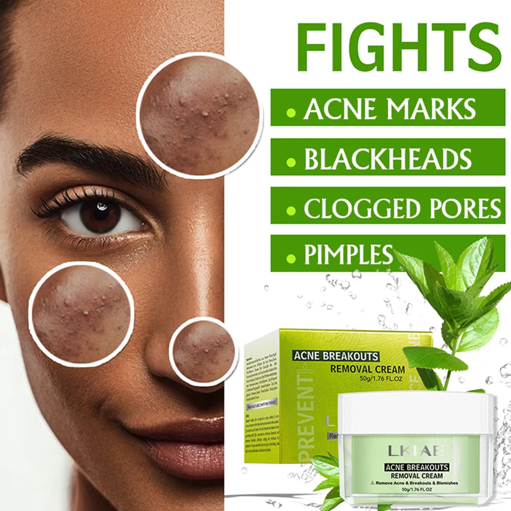 Boost Luster Organic Salicylic Acid Acne Removal Skin Care Face Anti Blemish Whitehead Remover Pimples Acne Cream for Face