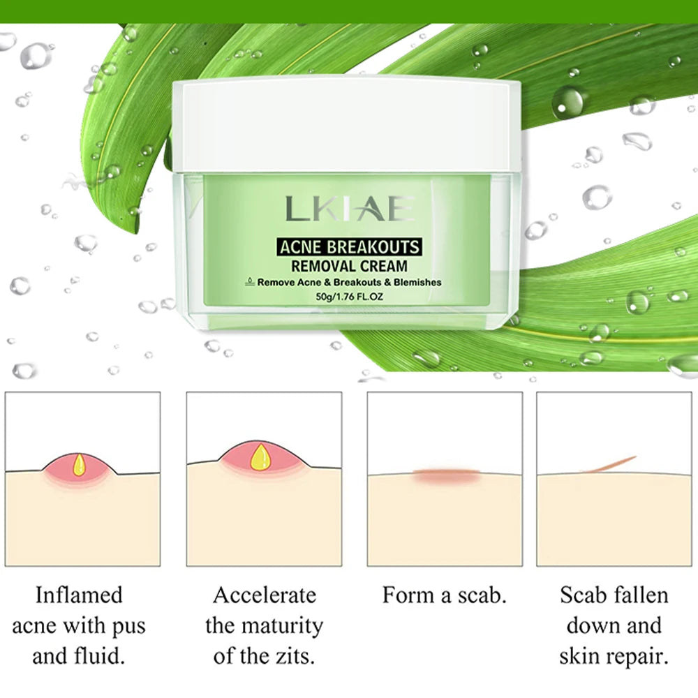 Boost Luster Organic Salicylic Acid Acne Removal Skin Care Face Anti Blemish Whitehead Remover Pimples Acne Cream for Face