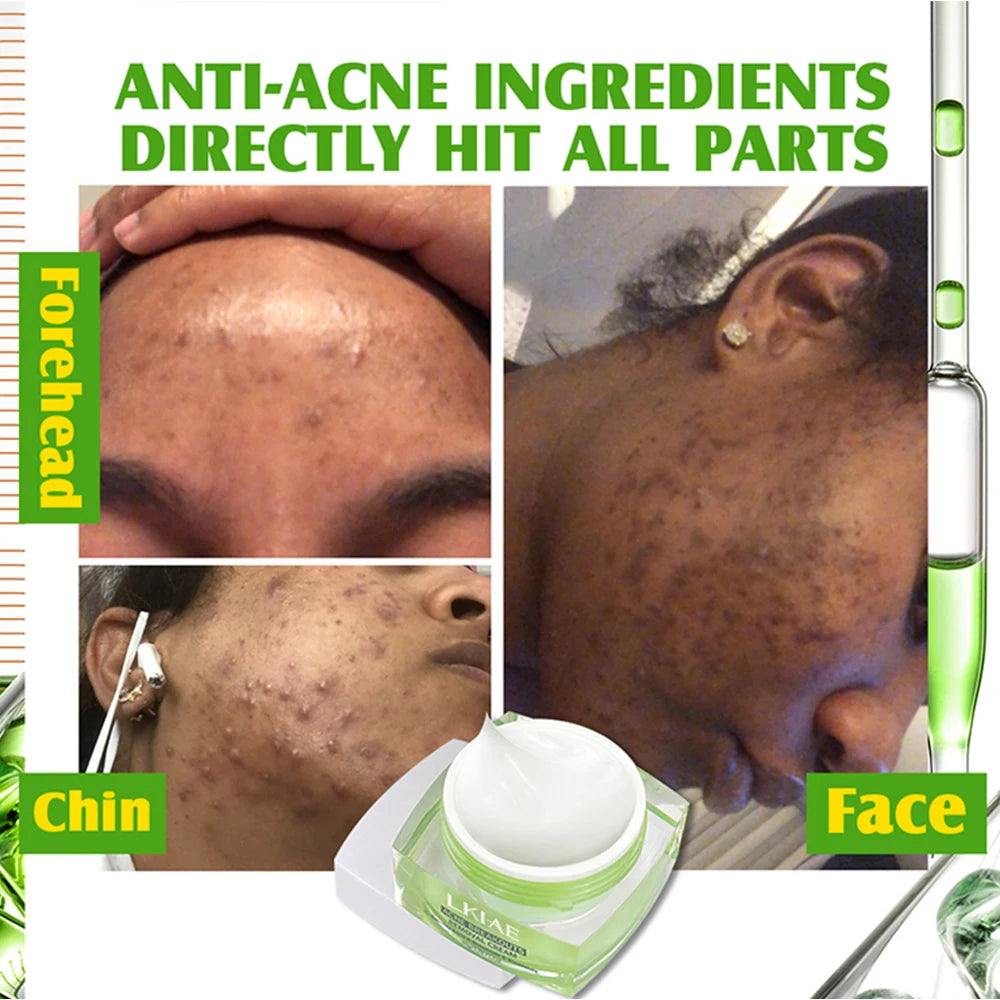 Boost Luster Organic Salicylic Acid Acne Removal Skin Care Face Anti Blemish Whitehead Remover Pimples Acne Cream for Face